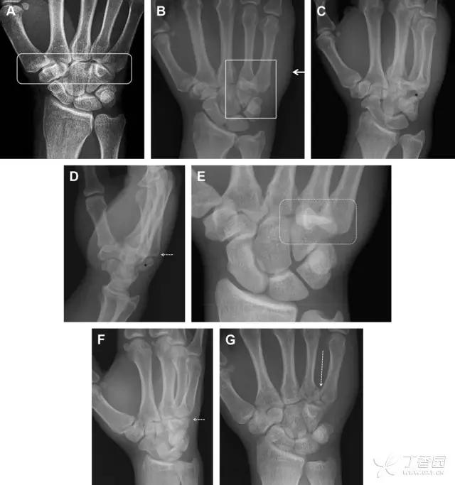 值夜班急救措施,放射科容易漏诊的骨折
