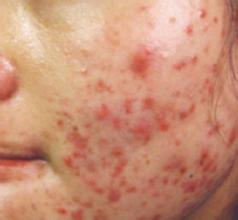 迅速解决青春痘的方法,青春痘怎么办最有效的方法