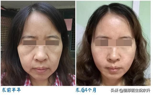 做了很多次医美法令纹还去不掉,法令纹的印子是不是去不掉了