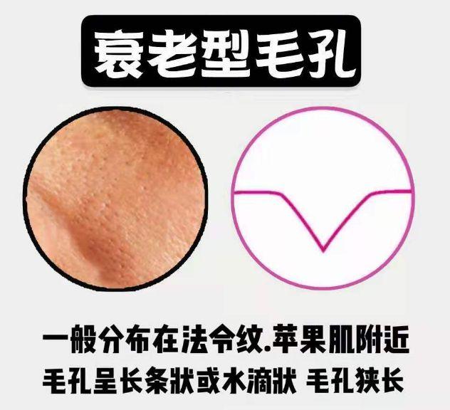 毛孔粗大黑头多怎么改善小技巧,毛孔粗大黑头多的原因和改善方法