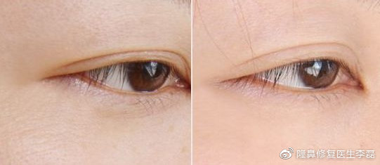 眼周细纹能整形解决吗,眼周皱纹很深怎么整形修复