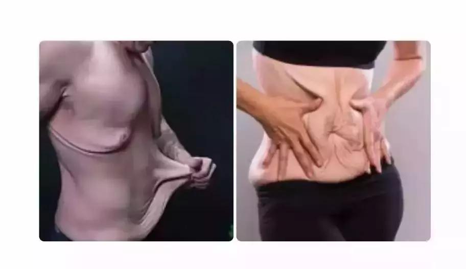 减肥后皮肤松弛吃补充什么维生素,减肥快皮肤松弛需要多久能恢复