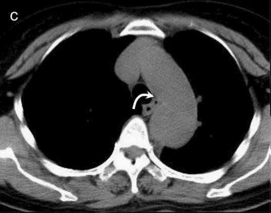 胸部Ct平扫能查出主动脉夹层吗,主动脉夹层cta影像图片解读