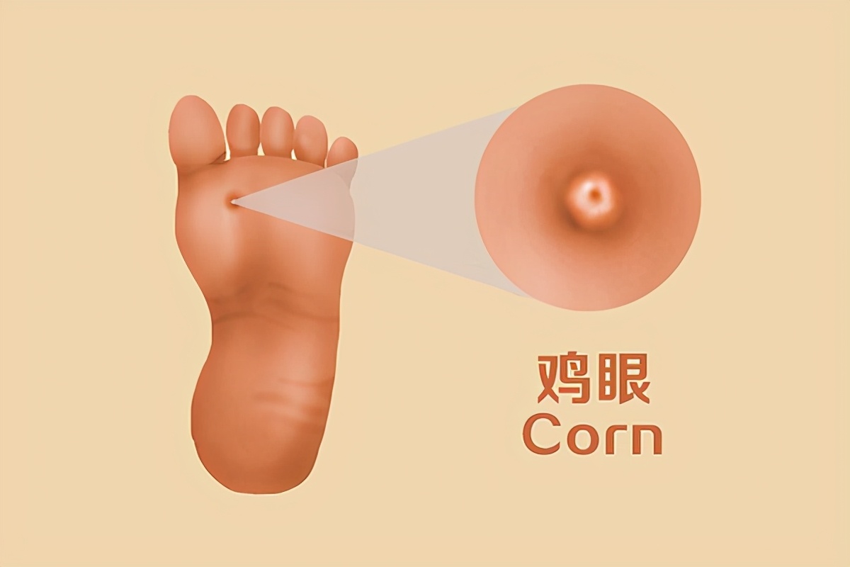 脚上长鸡眼最简单的去除方法,脚上长的鸡眼的处理方法