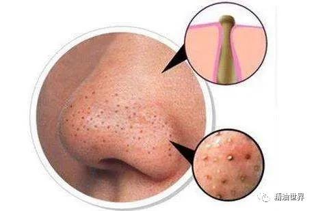 改善黑头精油,去黑头精油怎么配