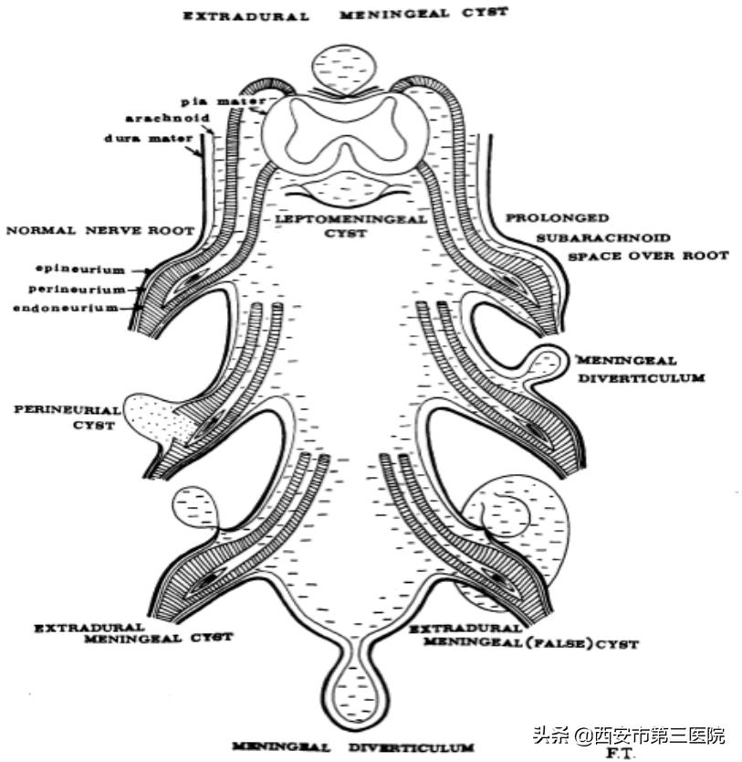 【医者解读】揭开“骶管囊肿”之神秘面纱，查出骶管囊肿都需要治疗吗？（手术病例+文献回忆）