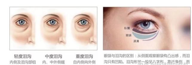 有黑眼圈怎么办如何去除黑眼圈,有黑眼圈该怎么办才能消除黑眼圈