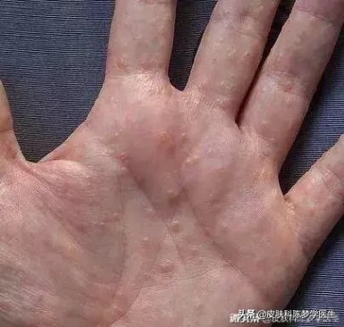 手上长了很多透明小水泡奇痒无比,天热手上起一片小水泡瘙痒