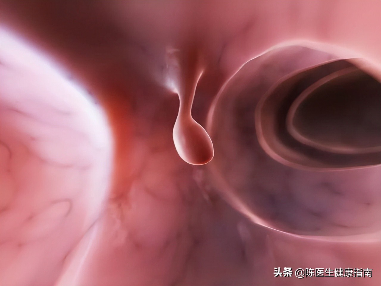 肠内有息肉都会出现哪些症状,肠内有息肉会有何症状