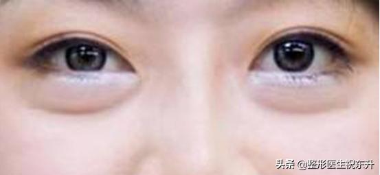 眼袋大用什么化妆品能修复,眼袋大怎么办用什么护肤品好