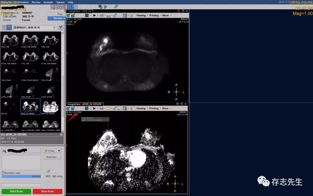 乳腺磁共振亲身经历,磁共振乳腺动态增强扫描全过程