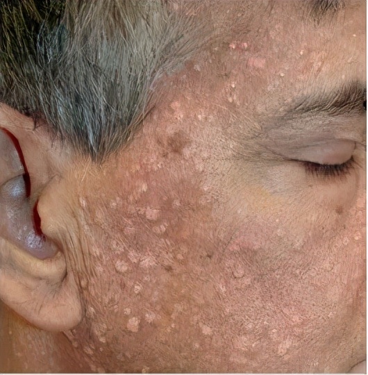 脸上长了闭口小颗粒怎么去除,脸上长白色小颗粒怎样去除掉