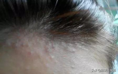 脸上部位长痘痘的原因分析图,脸上哪个部位长痘痘代表什么