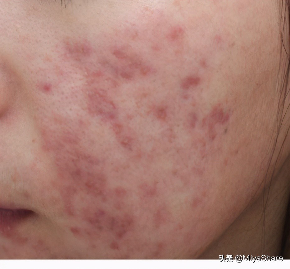 2分钟学会痘印如何快速消除,痘印怎么祛16个祛除痘印的小妙招