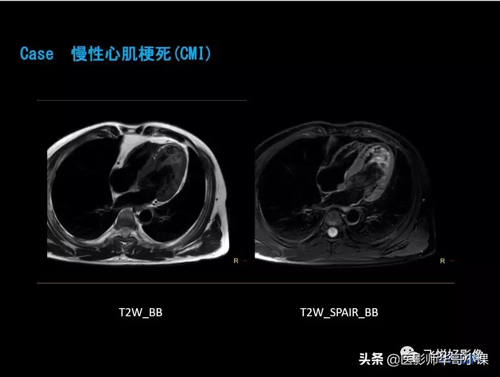 飞利浦核磁共振快速扫描,飞利浦磁共振心脏扫描