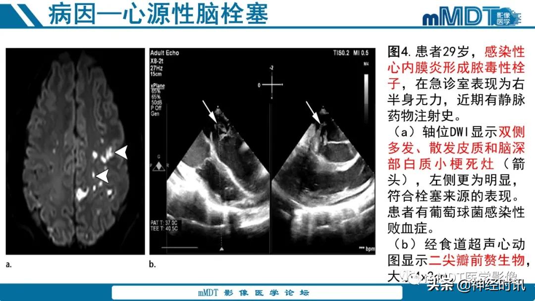 缺血性脑卒中护理课件,缺血性脑卒中讲课ppt