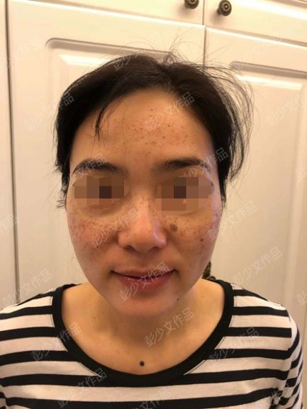 去除雀斑的有效方法是什么呢,祛雀斑和黄褐斑最好的方法