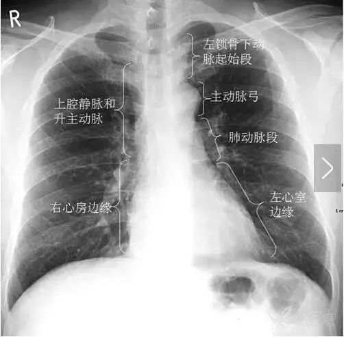 正常胸片图片,正常的胸片讲解