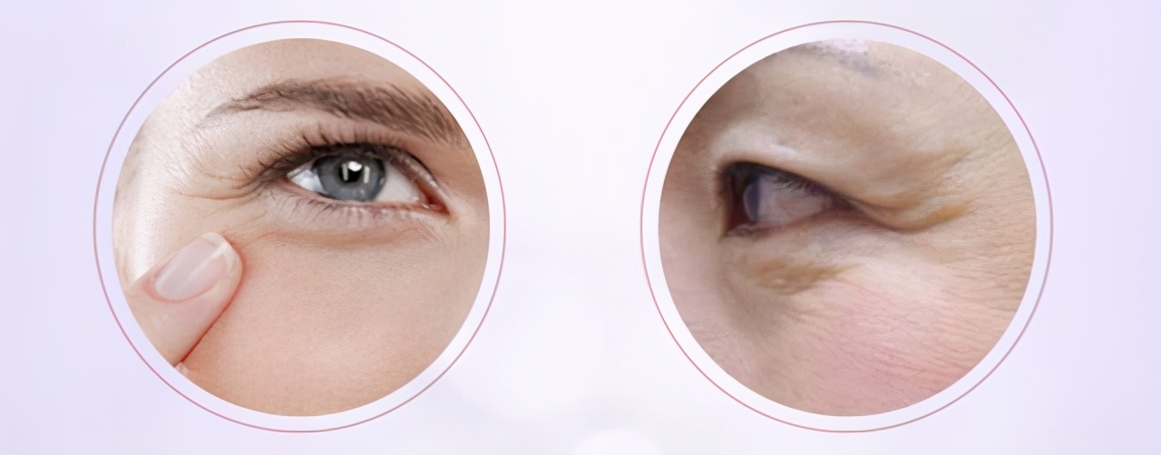 鱼尾纹至少有几条,鱼尾纹和眼角纹的区别图解