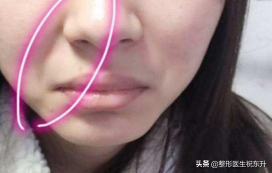 线雕和玻尿酸填充法令纹哪个安全,玻尿酸填充法令纹好还是线雕好呢