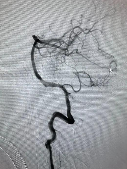来自空中的救援-动脉瘤治疗一例