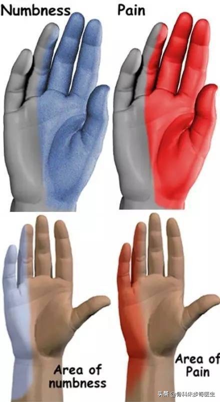 快速辨别手麻是否颈椎病引起,颈椎病手麻是什么原因