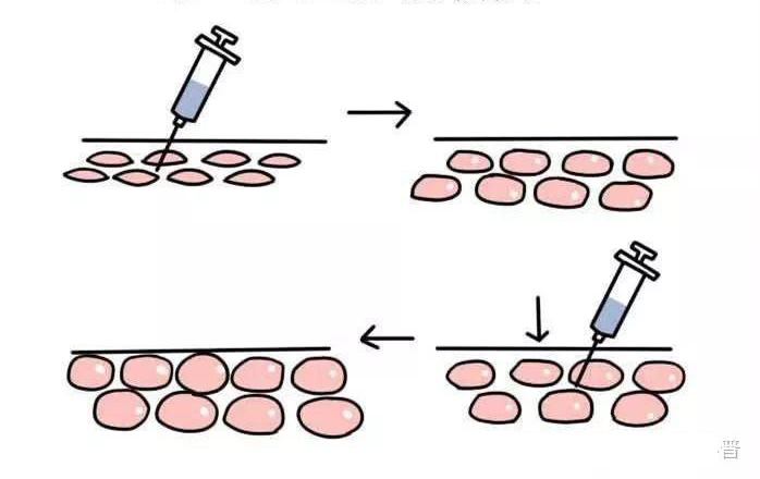 打了玻尿酸2年了还有效果,打了一支玻尿酸效果不好