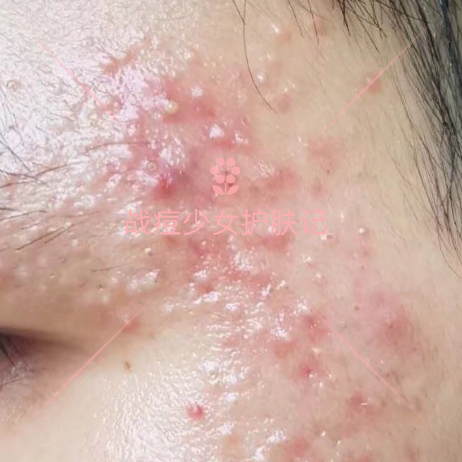 四招解决痘痘及痘痘的成因,痘痘不同原因类型及处理方法