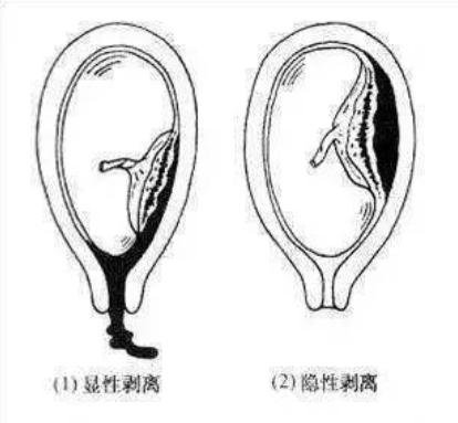 怎样解决孕期出血,孕期阴道出血的症状