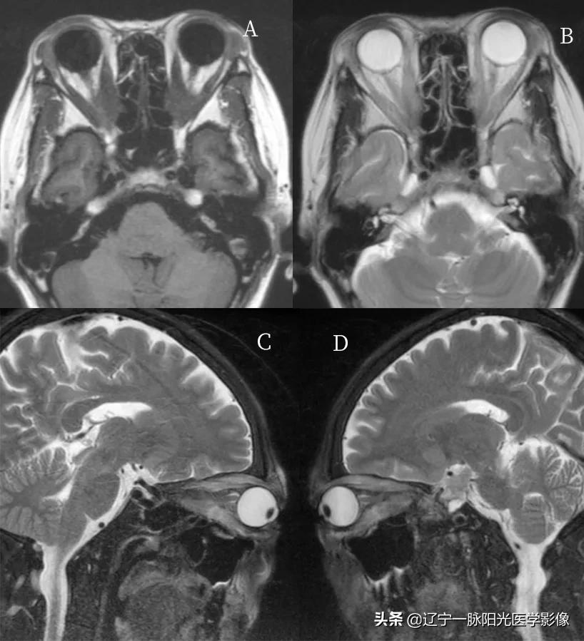 眼部肿瘤治疗有哪些,眼部肿瘤症状有哪些