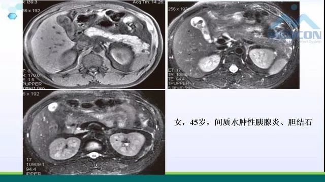 急性胰腺炎的护理措施,急性胰腺炎影像与临床