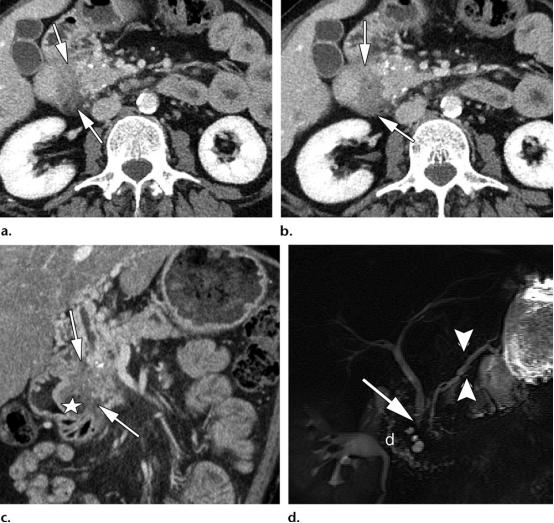 急性胰腺炎和慢性胰腺有什么症状,胰腺炎合并胰腺肿物