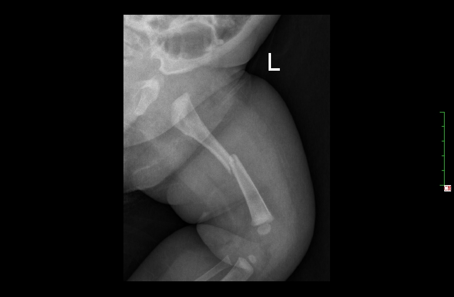 幼儿骨折误区,儿童骨折为什么好得快
