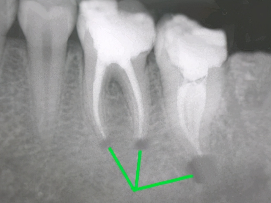 这些都能导致严重的牙疼，可以这样治疗？#雅悦齿科#