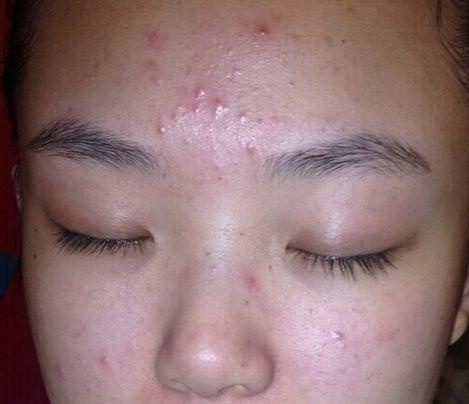 毛囊炎没得救？皮肤科主任推荐：3个便宜又好用的药，消除不反复