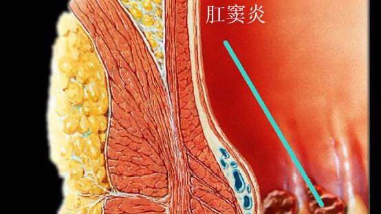 肛门坠胀老是有便意排不出来,肛门坠胀老有便意感觉有气排不出