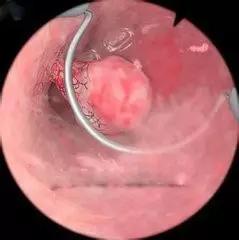 关于宫颈息肉的知识转载,宫颈小息肉是什么病严重吗