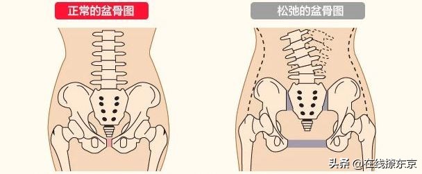 雅宝JAPAN推荐，骨盆矫正好物，产后骨盆变形的麻麻看过来
