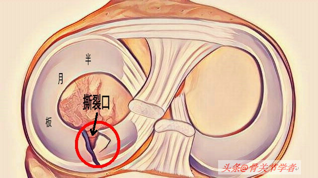 膝关节磁共振如何识别半月板损伤,磁共振半月板越来越严重怎么回事