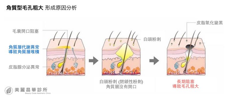 控油清洁毛孔,清洁控油收缩毛孔步骤