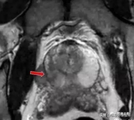 泌尿系统26种症状,泌尿系统的各疾病的体征汇总