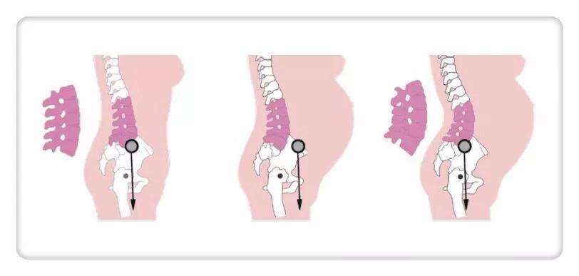孕早期干活了孕晚期腰痛怎么缓解,腰痛怎么办快速缓解腰痛