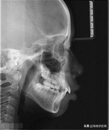 牙科拍片有多大危害？儿童和孕妇可以拍牙片吗？让牙匠周来捋一捋