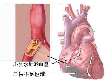 心肌缺血心绞痛用什么药好用,抗心肌缺血的药有哪些