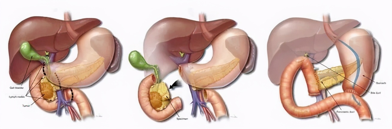 早期易忽视，发现即晚期，治疗效果差，胰腺癌为什么这么难？