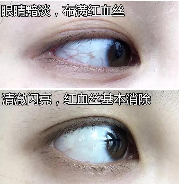 洗眼液什么情况不能用,洗眼液会不会有副作用