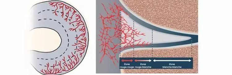 运动导致的半月板损伤的最好治疗,运动后半月板损伤怎么治疗