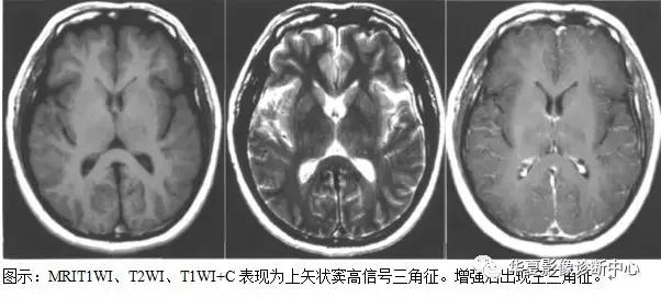 颅脑核磁影像解剖图谱,颅脑mr增强影像图片