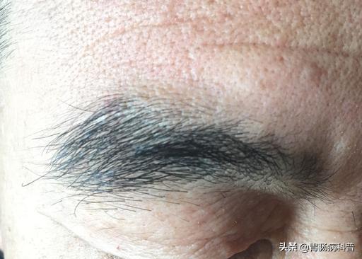 70岁老太太患上了癌症,老年人双下肢长出黑毛毛