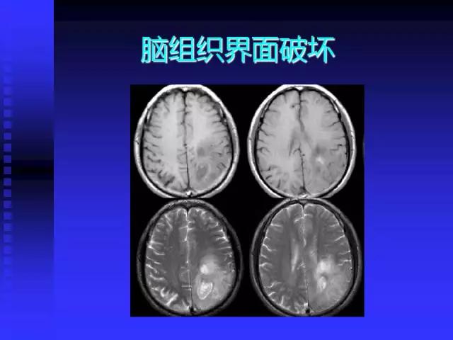 头颅mri读片视频教程,颅脑mri读片入门教程视频讲解全集